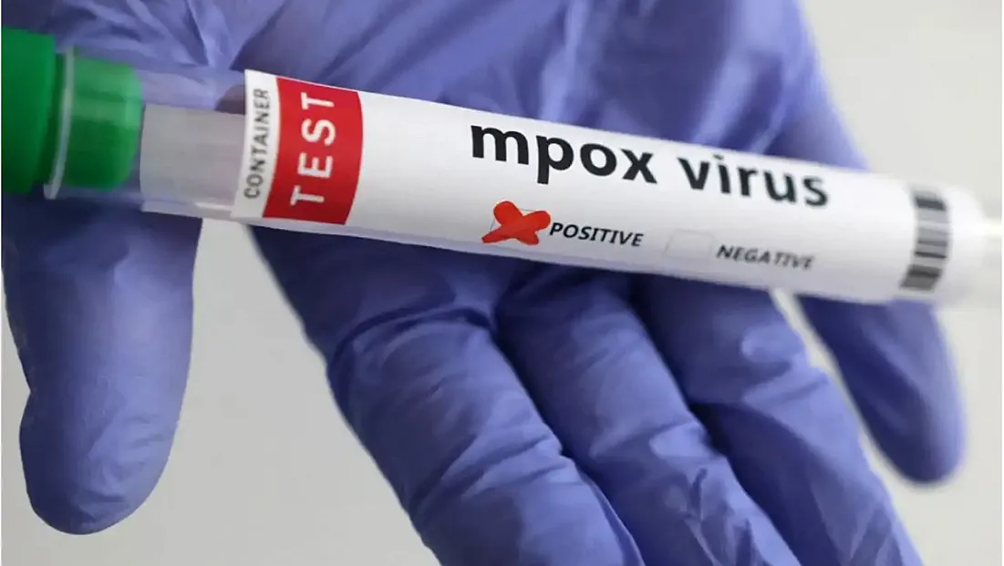 Mpox Virüsünde Yeni Rekombinant Varyant İngiltere’de Ortaya Çıktı!