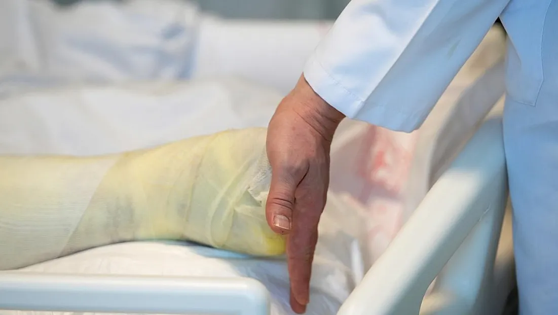 Yanık Tedavisinde Başarı Yükseliyor Hedef İlk Müdahale Kalitesi