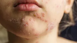 Profesörden Korkutan Kızamık Uyarısı! 8 Yıl Sonra Bitkisel Hayata Sokabilir