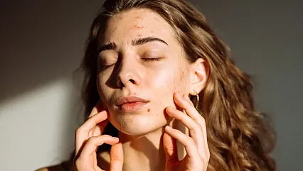 Sivilceleriniz Sizinle Konuşuyor! Hangi Bölgedeki Akne Ne Anlama Geliyor