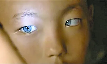 Çocuklarda Sakarlık Sanılan Belirti Tavuk Karası Olabilir!