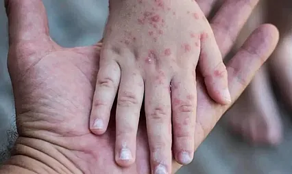 Son 25 Yılın En Yüksek Kızamık Artışı! DSÖ'den Küresel Alarm: Salgın Tehlikesi Kapıda