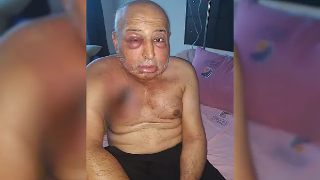 Kemoterapi vücudunu bu hale getirdi! Kanser hastası adam yardım bekliyor