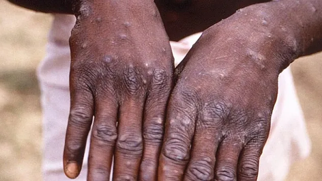 Afrika'da maymun çiçeğine karşı aşılamalara başlanacak