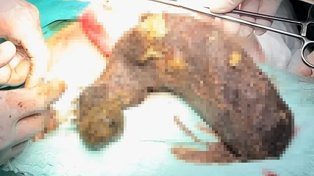 Genç kızın karnından 2 kilogram kıl yumağı çıktı