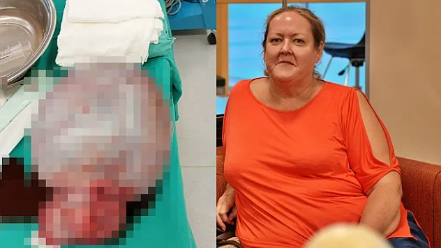 İngiliz hastanın karnından 6 kilogram kitle çıkarıldı