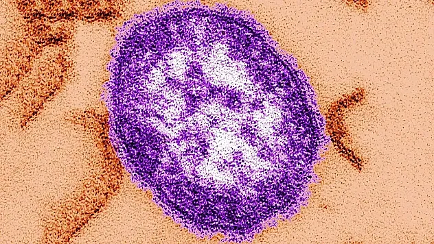 ABD'de Kızamık Salgını Yeniden Yayılıyor