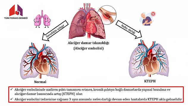 'Sinsi Tehlike KTEPH': Nefes Darlığını Yaşlanmaya Bağlamayın! Uzmanlardan Hayat Kurtaran Uyarı