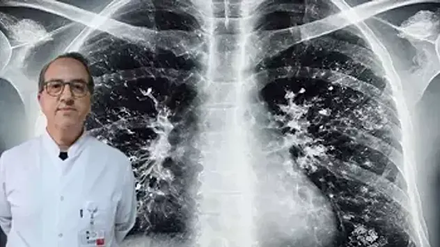 Uzmandan Kritik 'Süperenfeksiyon' Uyarısı! Grip Sonrası Tehlike Büyüyor: Zatürre Olduğunuzu Bile Anlamayabilirsiniz