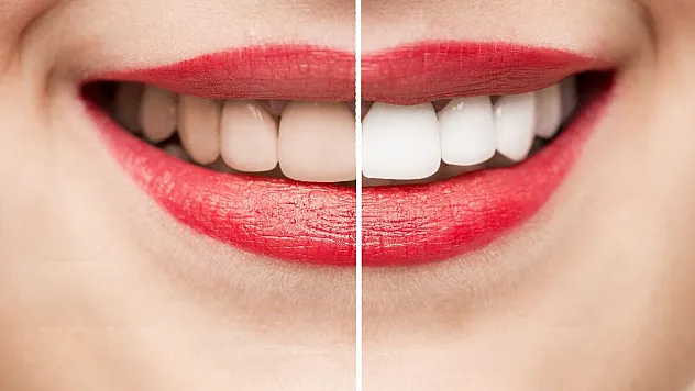 Uzmanlar Uyarıyor: Diş Çürüğü Kalpten Beyne Kadar Tüm Vücudu Etkiliyor