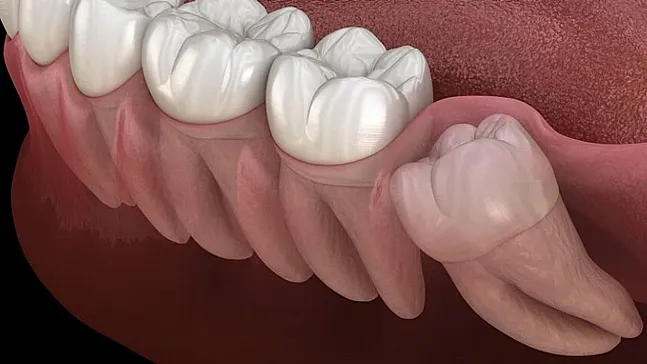 Geleceğin Sağlık Anahtarı Olan Yirmilik Dişler Kalp Dokusunu Yenileme Potansiyeliyle Tıp Dünyasını Sarsıyor