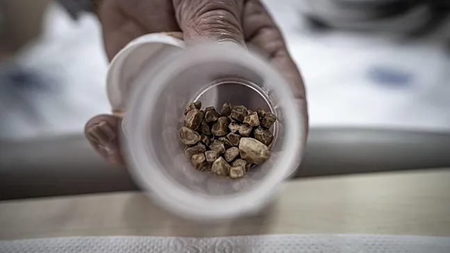 İstanbul'da Çare Bulamadı, Erzurum'da Şifa Buldu! Kanaldan Çıkan 51 Taş Şoke Etti