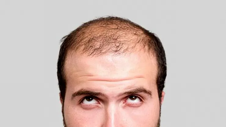 Saç ektirmedeki büyük tehlike ne?