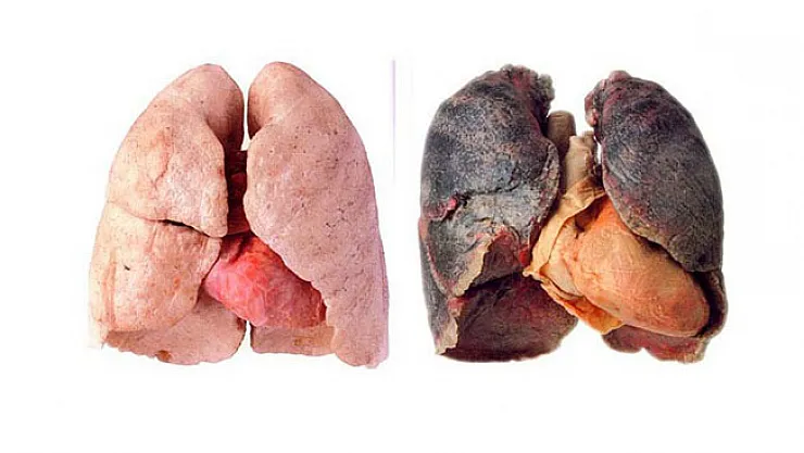 İşte sigara kullanımın ortaya çıkardığı tablo