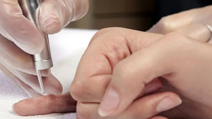 Siğillerden basit yöntemlerle nasıl kurtulabilirsiniz?