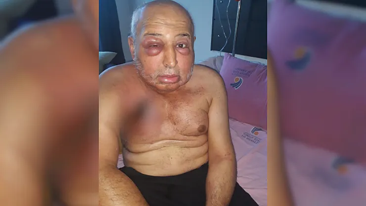 Kemoterapi vücudunu bu hale getirdi! Kanser hastası adam yardım bekliyor