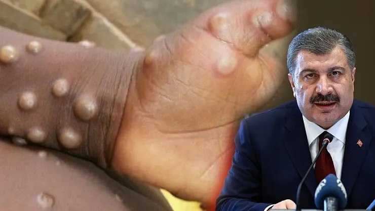 Bakan Koca açıkladı… Türkiye'de 'maymun çiçeği' vakası yok!