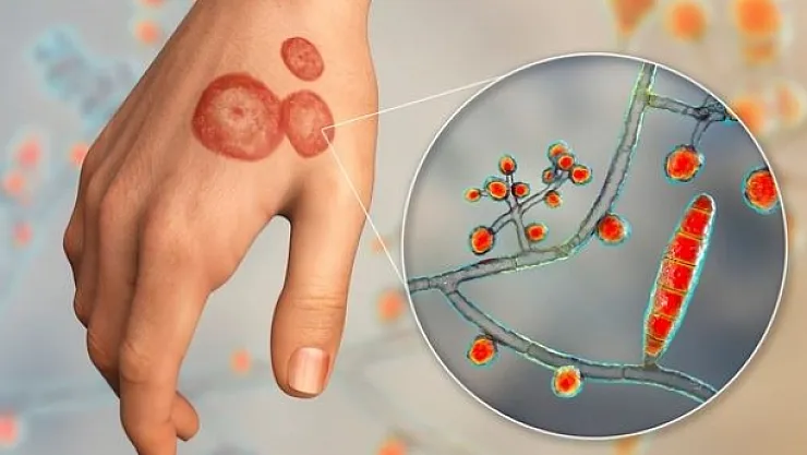 Uzmanlar uyarıyor! Mantar enfeksiyonlarında artış!