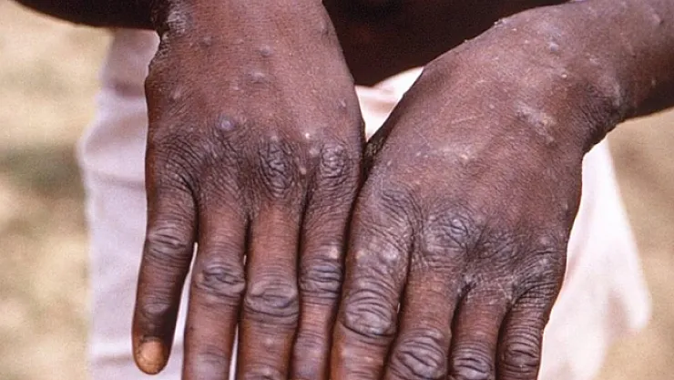 Afrika'da maymun çiçeğine karşı aşılamalara başlanacak