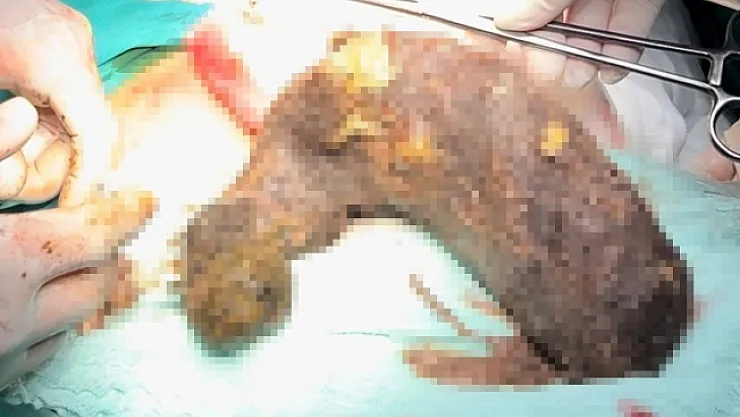 Genç kızın karnından 2 kilogram kıl yumağı çıktı