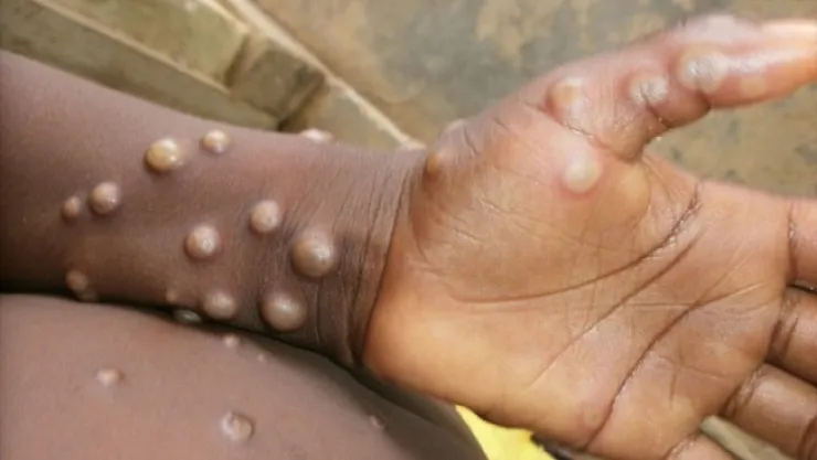 Maymun çiçeğinden korunma yolları...