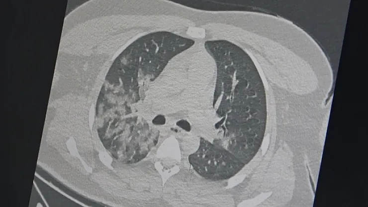Kanıtlandı! Artan ani genç ölümlerin sebebi Kovid-19