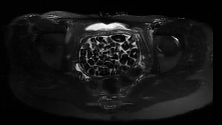 287 Taşla Gelen Şifa: Genç Kızın Ameliyatı Tıp Literatürüne Girebilir