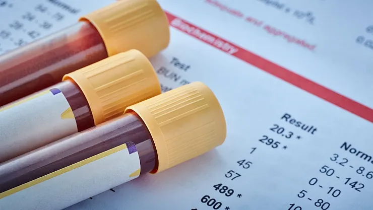 40 Yaşından Sonra Hayati Önem Taşıyan 3 Kan Testi: Uzmanlar Uyardı, Geciktirmeyin!