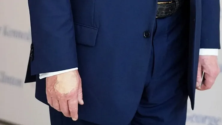 Beyaz Saray'dan 'Trump'ın Elindeki Renk Değişimi' İddialarına Yalanlama