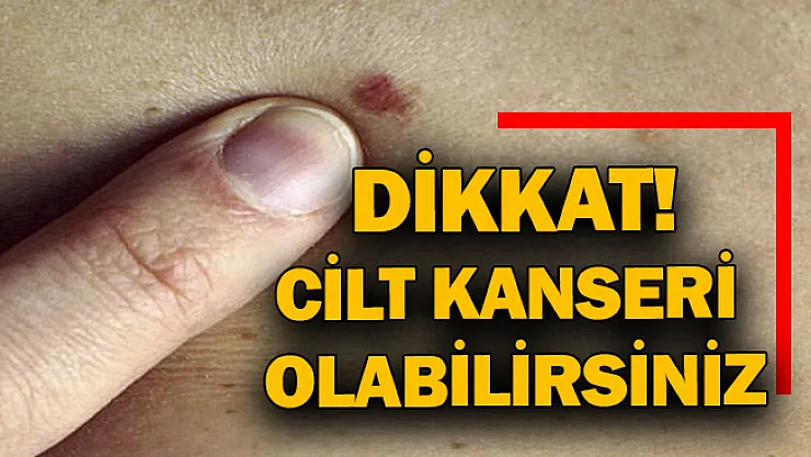 Dikkat! Cilt kanseri olabilirsiniz