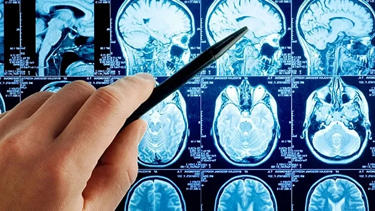 Dünyada Sadece 13 Kişide Görülen Yeni Hastalık Tespit Edildi: Bilim İnsanları 'Eşi Benzeri Yok' Dedi