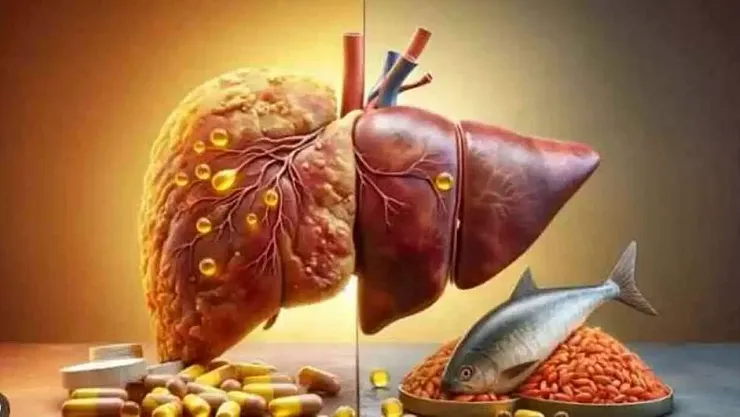 Karaciğer Yağlanmasının Genetik Nedeni Ortaya Çıktı: Bilim İnsanlarından Umut Veren B3 Vitamini Keşfi