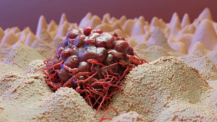 Kemik Ağrılarını Göz Ardı Etmeyin: Yumuşak Doku Tümörleri Hayati Risk Taşıyabilir