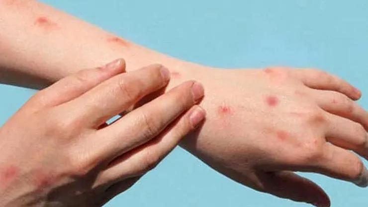 Kızamık Salgını: 17 Can Kaybı, Aşı Seferberliği Başladı