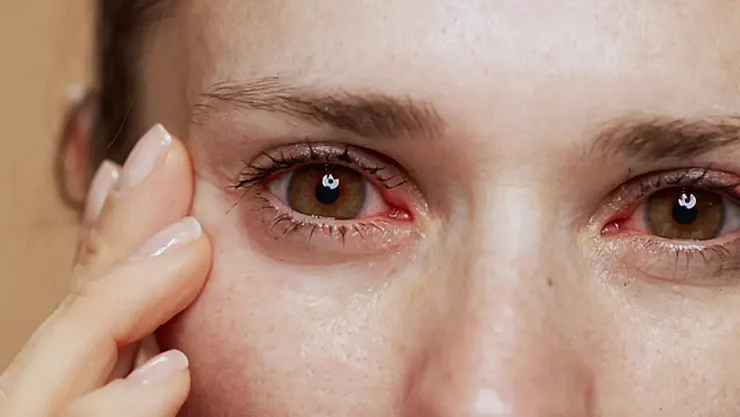 Mevsimsel Göz Alerjileri Göz Sağlığını Tehdit Ediyor