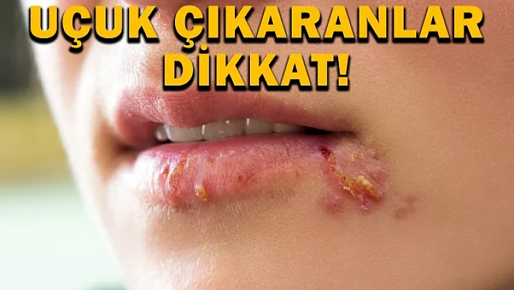 Uçuk çıkaranlar dikkat!