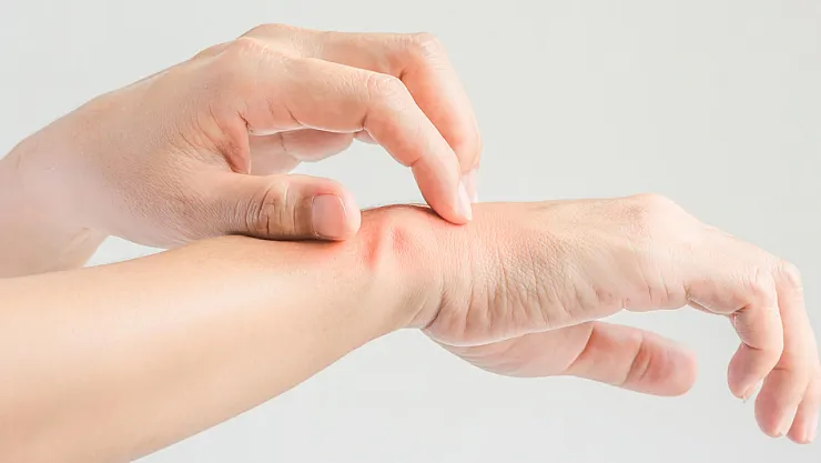 Yaralar Neden Kaşınır? Bilim İnsanları İyileşme Sürecinin Gizli Sırrını Açıkladı