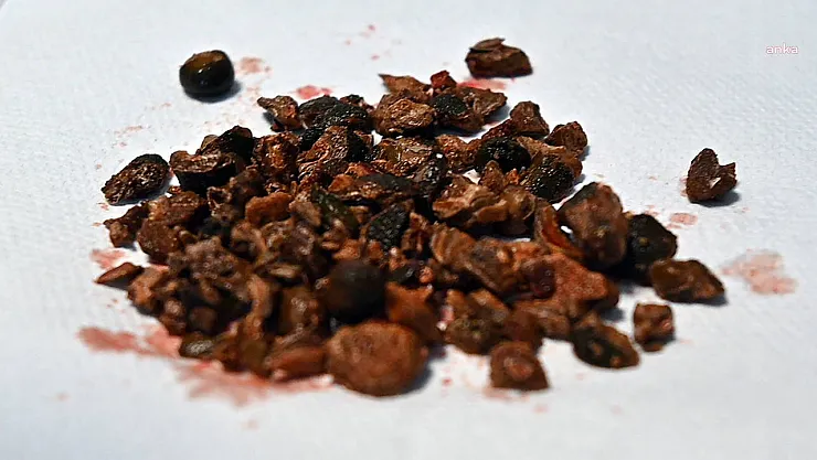 Yozgat'ta şaşırtan ameliyat: 45 yaşındaki hastanın böbreğinden 100'e yakın taş çıkarıldı