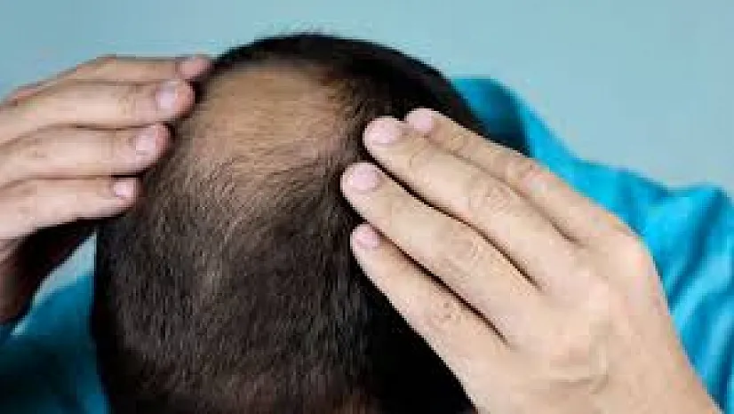Erkek Tipi Saç Dökülmesinde Çığır Açan Tedavi! Yeni İlaç Saç Çıkışını Yüzde 539 Artırdı